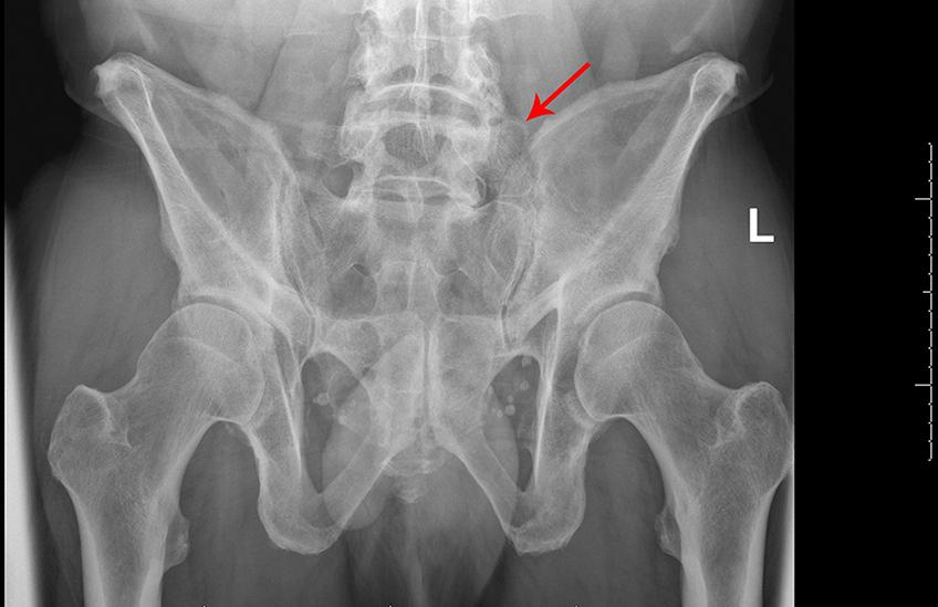 Fig. 1.2, Left Castellvi type IIa transitional vertebrae.