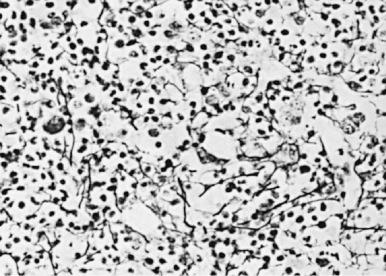 Figure 1-2, Bone marrow biopsy of a patient with mild myelofibrosis showing a slight increase in the number of reticulin fibers in a delicate discontinuous fiber network. (Gomori stain ×350.)