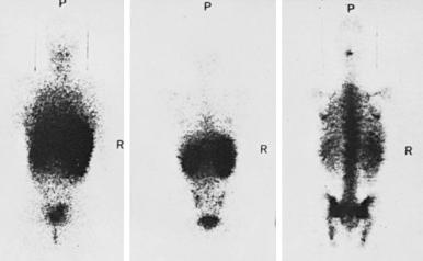 Figure 1-10, Spectrum of scintigraphic patterns in patients with idopathic aplastic anemia. On the left is a scintigram of a patient prior to transplantation with renal activity but no marrow activity. In the middle is a scintigram of a patient with activity in the kidneys and borderline uptake within the marrow. On the right is a normal bone marrow scan in a patient after transplantation. Liver activity is seen in all three patterns, and splenic activity is seen in none.