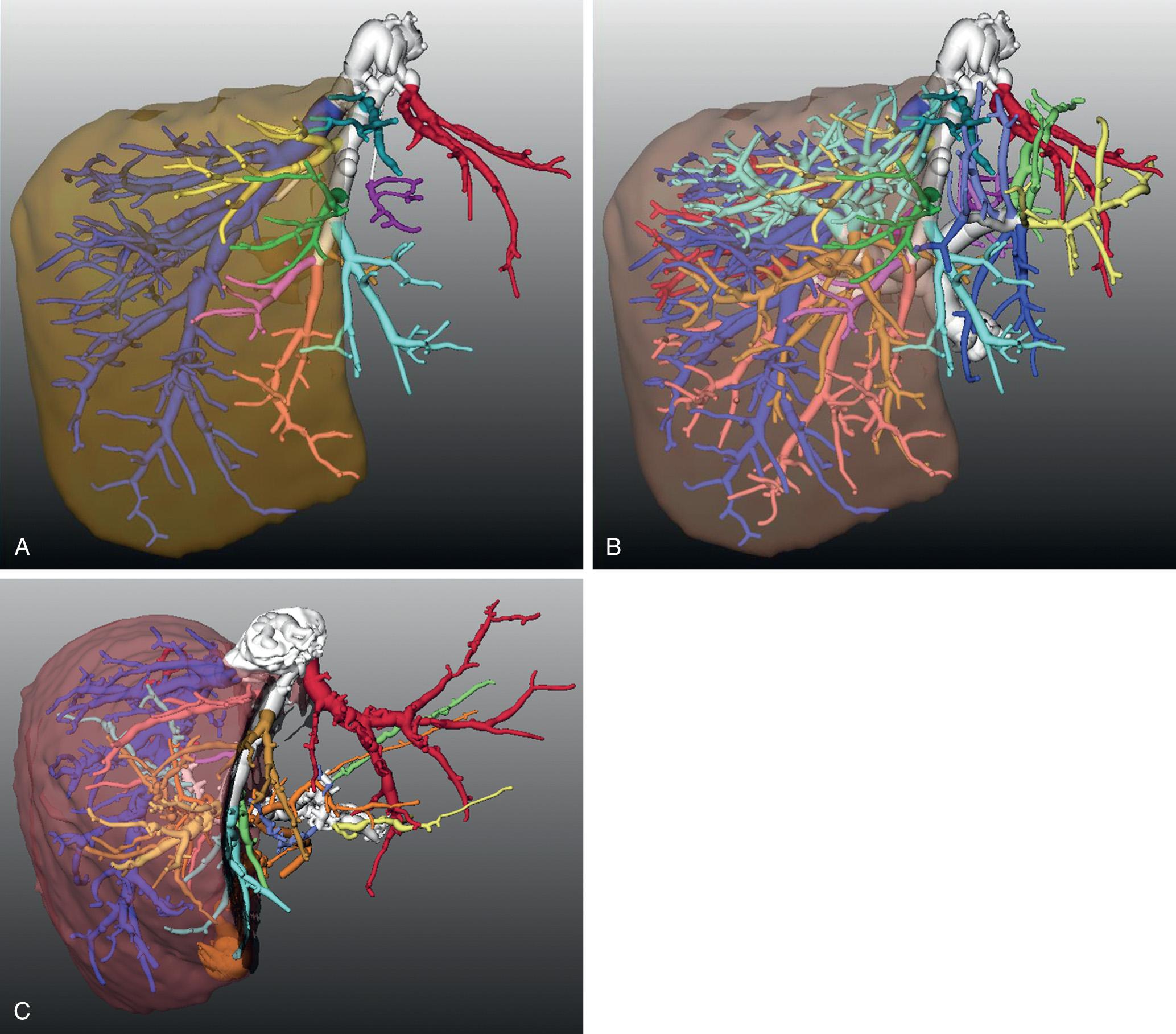 FIGURE 118.6, Virtual three-dimensional reconstruction of the liver anatomy by means of Hepavision, MeVis-Germany software. The right lobe has been reconstructed in a virtual fashion, together with the hepatic veins (A), hepatic veins and portal veins (B), and hepatic veins and biliary system (C).