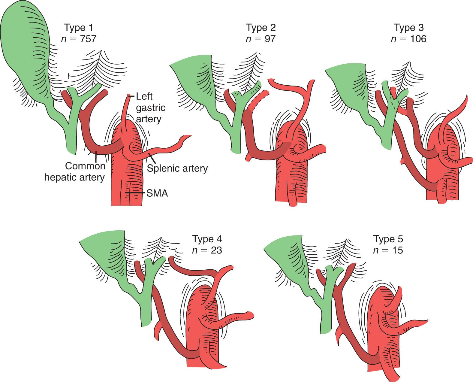 FIGURE 86.4, Hepatic arterial anatomy in 998 cases. Dotted lines indicate that the variant artery may be accessory (if branch shown by dotted line is present) or replaced (if absent). Type 1, normal; type 2, replaced (accessory) left hepatic artery from left gastric; type 3, replaced (accessory) right hepatic artery from superior mesenteric artery (SMA); type 4, double replaced system; and type 5, common hepatic artery from SMA. In two patients (not shown), the common hepatic artery arose directly from the aorta.