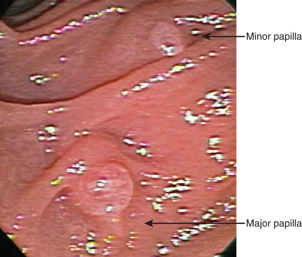 FIGURE 71.6, Endoscopic image of the major papilla and proximal minor papilla.