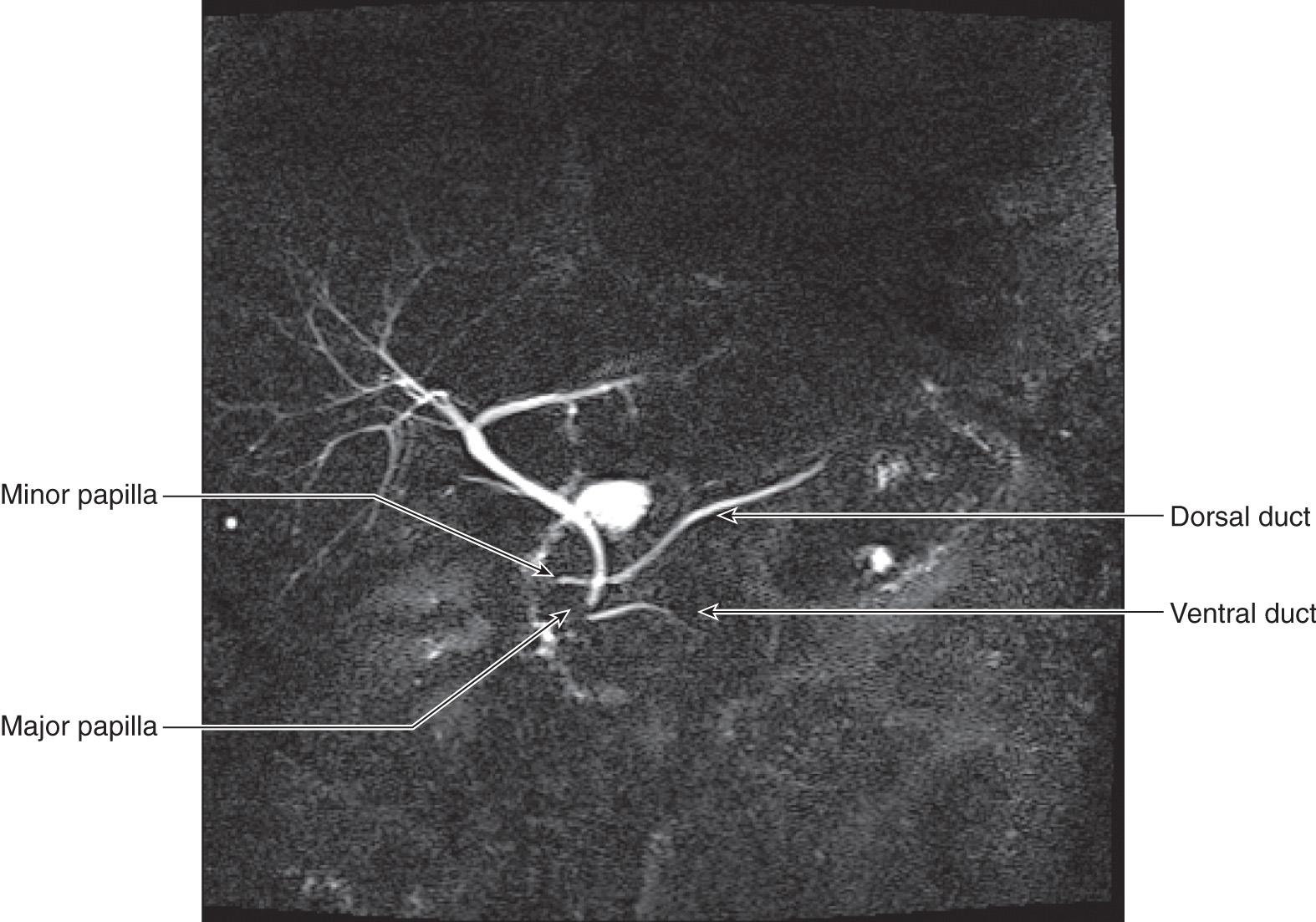 FIGURE 71.7, Magnetic resonance cholangiopancreatographic image demonstrating pancreas divisum with drainage of the dorsal duct through the minor papilla.