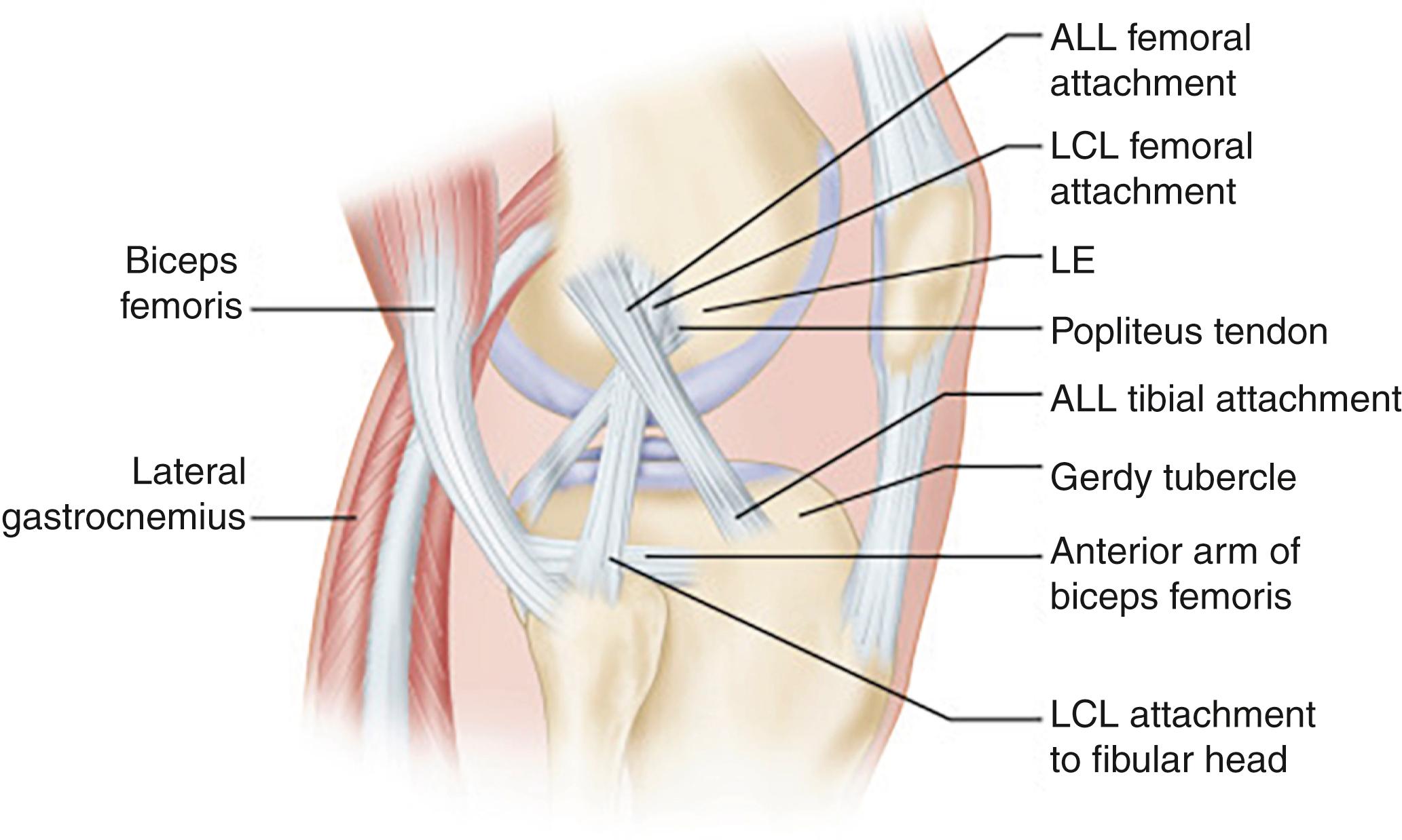 Fig. 1.5, Knee joint, lateral view. Osseous landmarks and attachment sites of the main structures of the lateral knee (IT band and nonanterolateral ligament–related capsule removed). The femoral attachment of the ALL is located posterior and proximal to the lateral collateral ligament; it courses anterodistally to its anterolateral tibial attachment approximately midway between the center of Gerdy’s tubercle and the anterior margin of the fibular head. ALL , Anterolateral ligament; LCL , lateral collateral ligament; LE , lateral epicondyle.