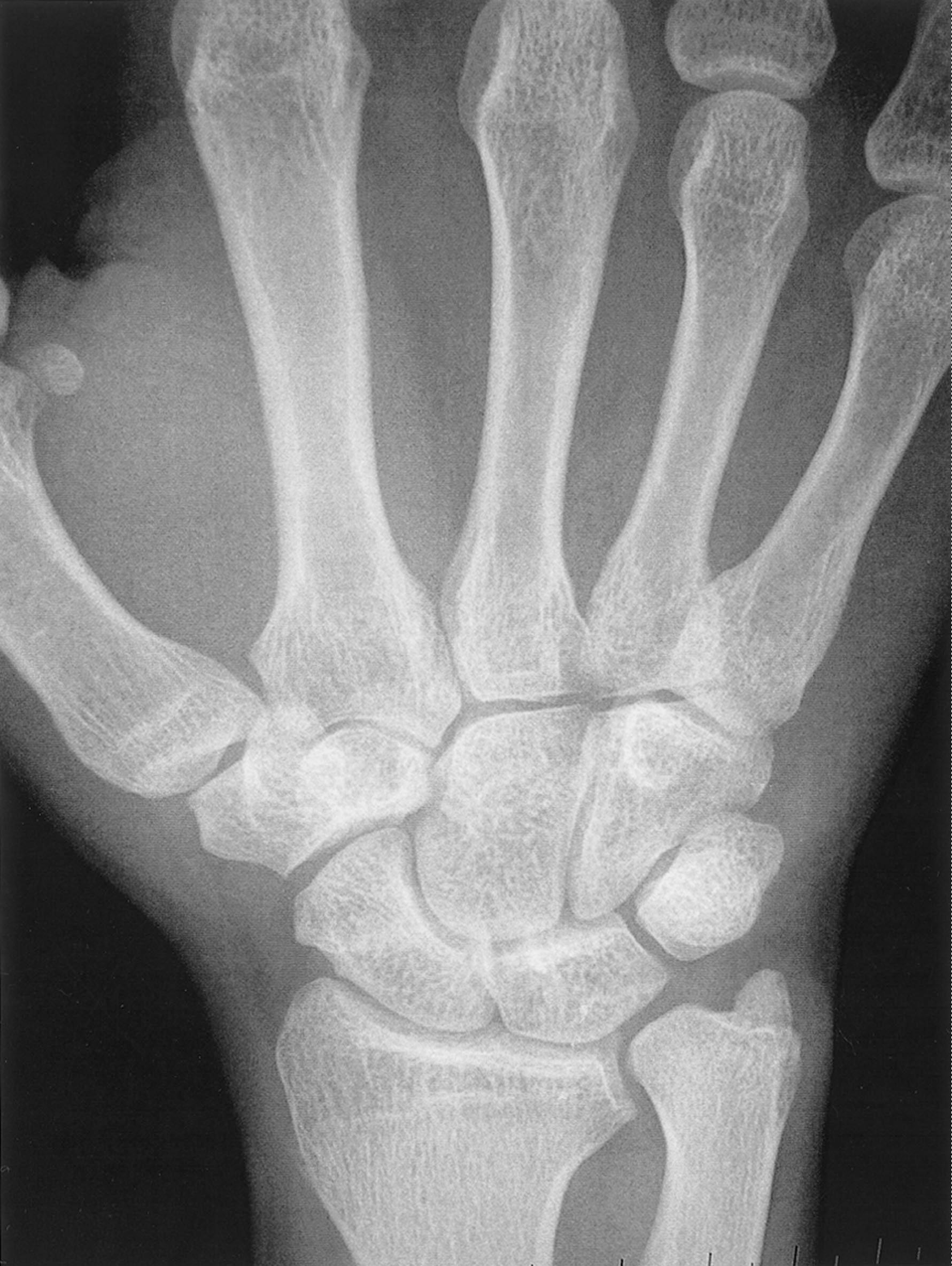 Figure 1.11, X-ray of ulnar positive variance: this patient has ulnar-sided wrist pain due to ulnar impaction syndrome.