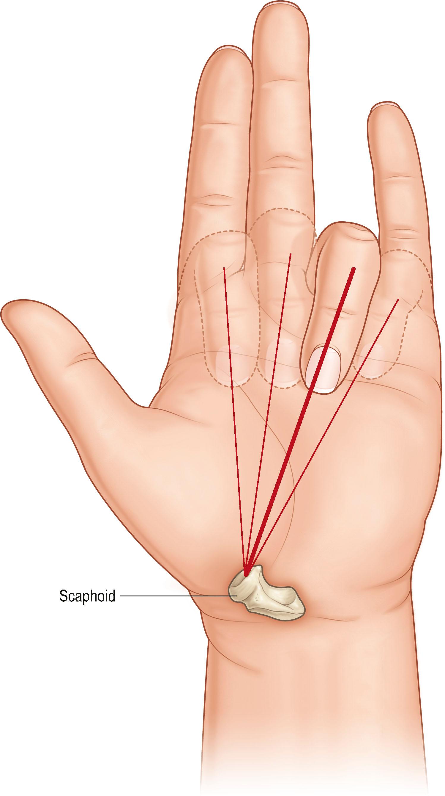 Figure 1.13, Each finger in correct alignment points to the tubercle of the scaphoid when flexed individually.