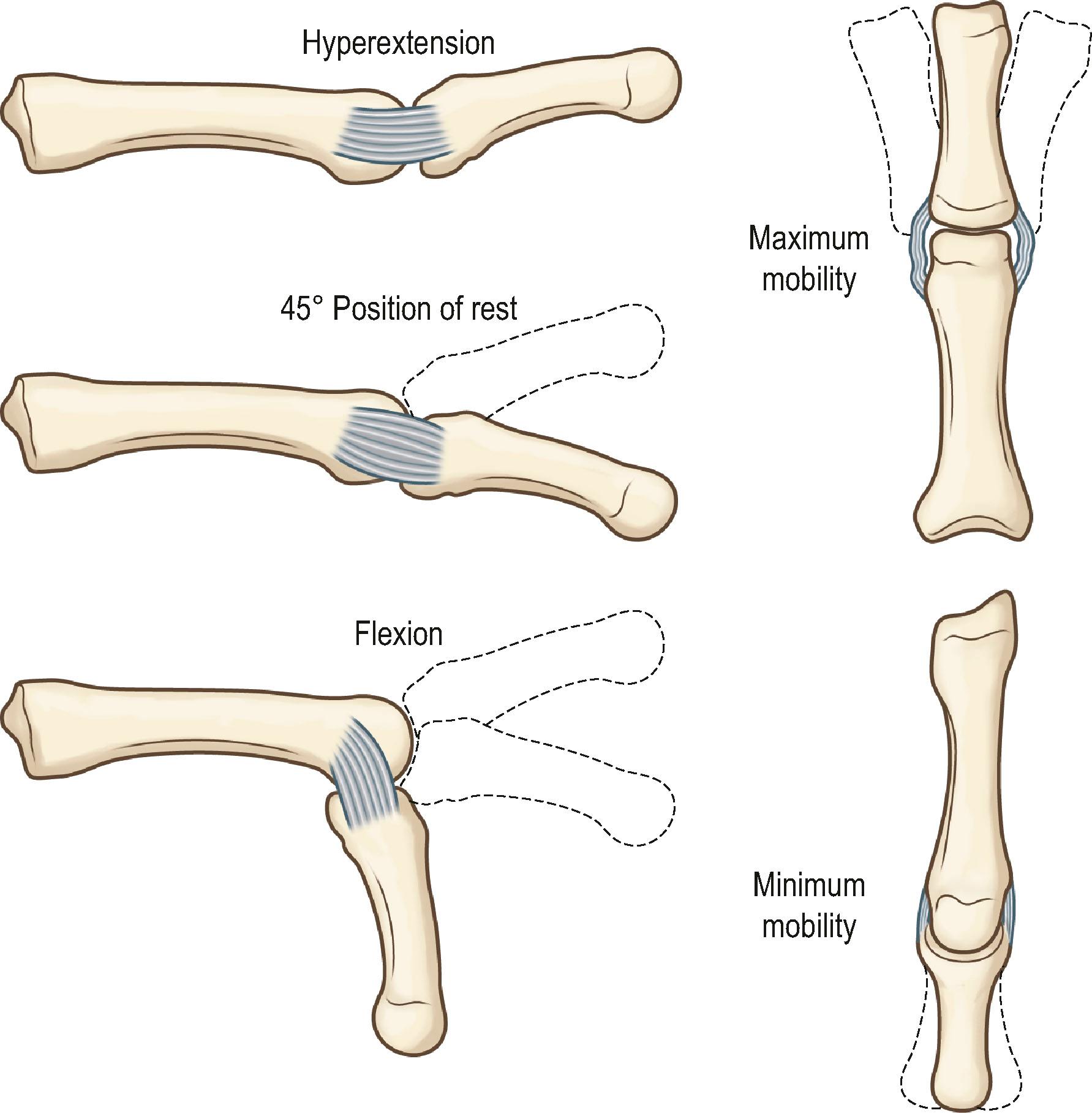 Figure 1.15, The true collateral ligaments of the metacarpophalangeal joint are loose in extension but tight in flexion of the joint as a result of the cam effect of the metacarpal head in relationship to the proximal phalanx. This accounts for the lack of lateral mobility of the joint when it is flexed.