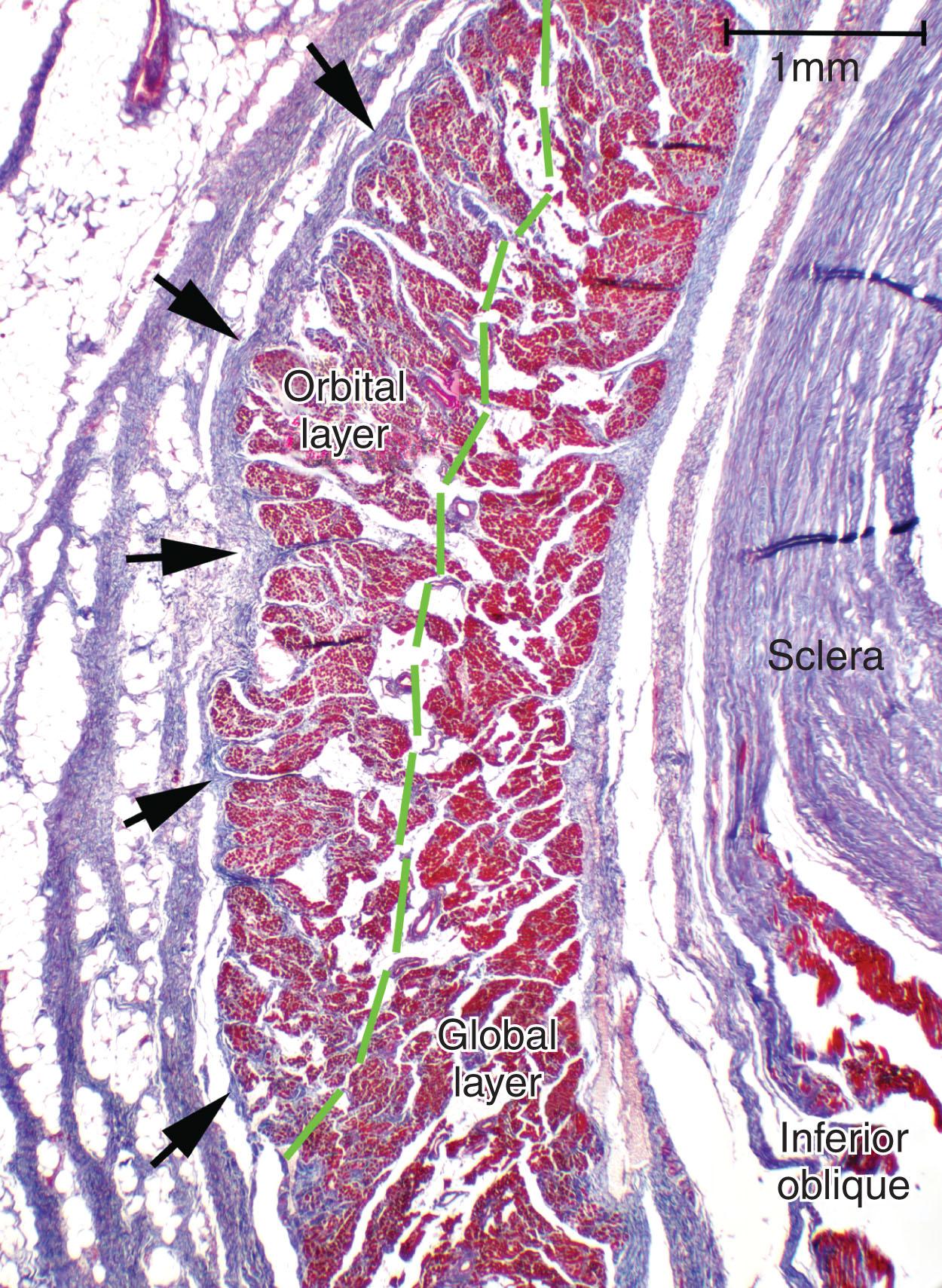 Fig. 75.1, Transverse histological section of 17-month-old human lateral rectus (LR) muscle stained with Masson's trichrome showing the smaller, darker-red staining fibers of the orbital layer (OL) to the left of the larger, brighter-red staining fibers of the global layer at right. Note insertion of OL fibers into the dense blue-staining collagen of the LR pulley (arrows). The inferior oblique muscle insertion into the blue-staining collagen of the sclera is seen at lower right.