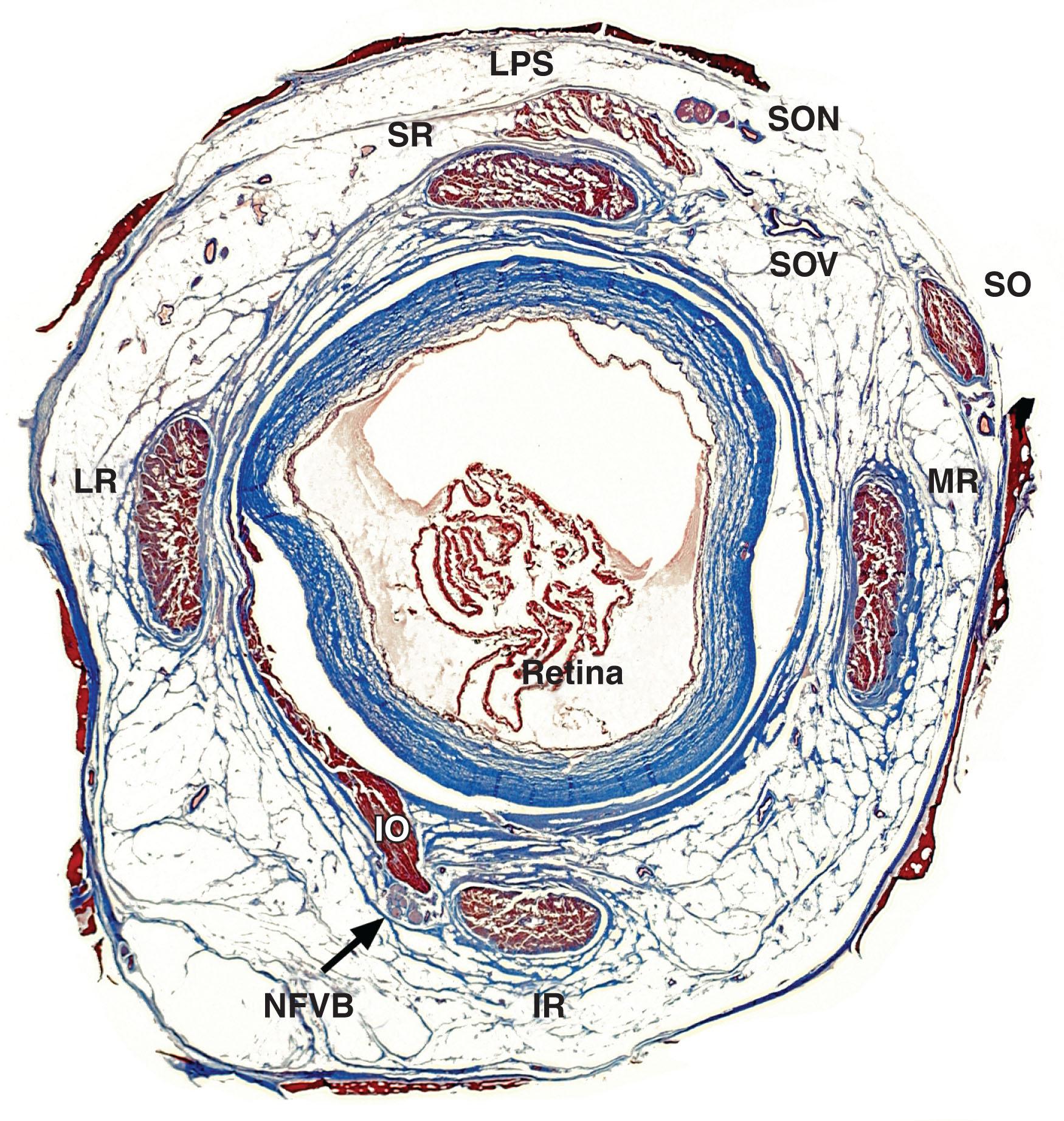 Fig. 75.3, Quasi-coronal (perpendicular to orbital axis) histological section of 17-month-old whole human orbit stained with Masson's trichrome showing encirclement of the inferior rectus (IR), lateral rectus (LR), medial rectus (MR), and superior rectus (SR) muscles by the dense, blue-staining collagenous rings of their pulleys. The main part of the inferior oblique (IO) pulley is slightly anterior to this section, but can be seen in part as a dense collagenous mass adjacent to the muscle belly and its neurofibrovascular bundle (NFVB). The retina is detached as a postmortem artifact. LPS, levator palpebrae superioris muscle; SO, superior oblique muscle; SON, supraorbital nerve; SOV, superior orbital vein.