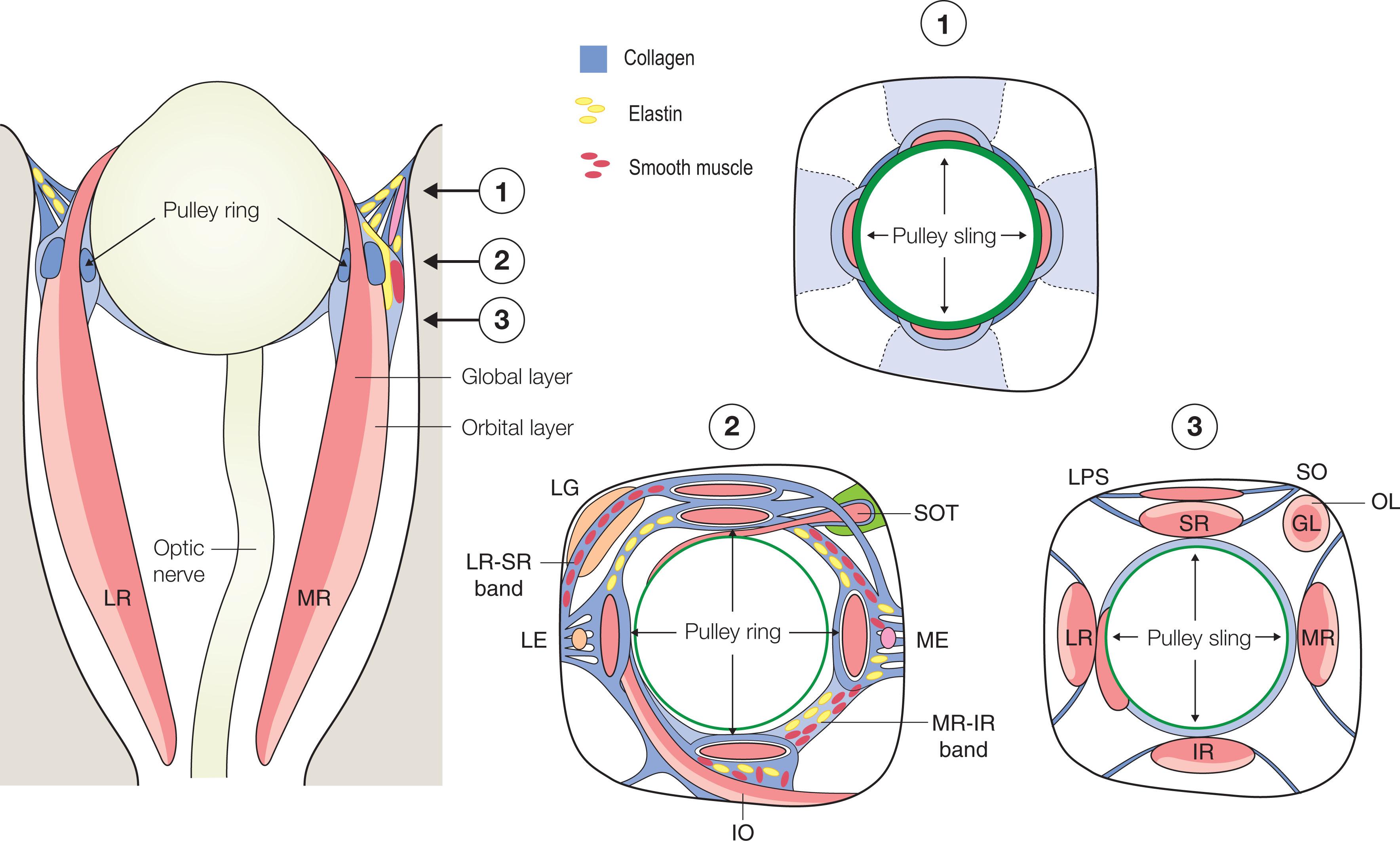 Fig. 75.4, Schematic of orbital connective tissues. Coronal views are depicted at three levels from the axial view. The functional pulleys are at the level depicted at lower right. Tissue composition is color coded as shown at right. GL, global layer; IO, inferior oblique muscle; IR, inferior rectus muscle; LG, lacrimal gland; LE, lateral enthesis, the attachment of the pulley suspension to the orbital wall; LPS, levator palpebrae superioris muscle; LR, lateral rectus muscle; ME, medial enthesis, the attachment of the pulley suspension to the orbital wall; MR, medial rectus muscle; SO, superior oblique muscle; SOT, superior oblique tendon; SR, superior rectus muscle.