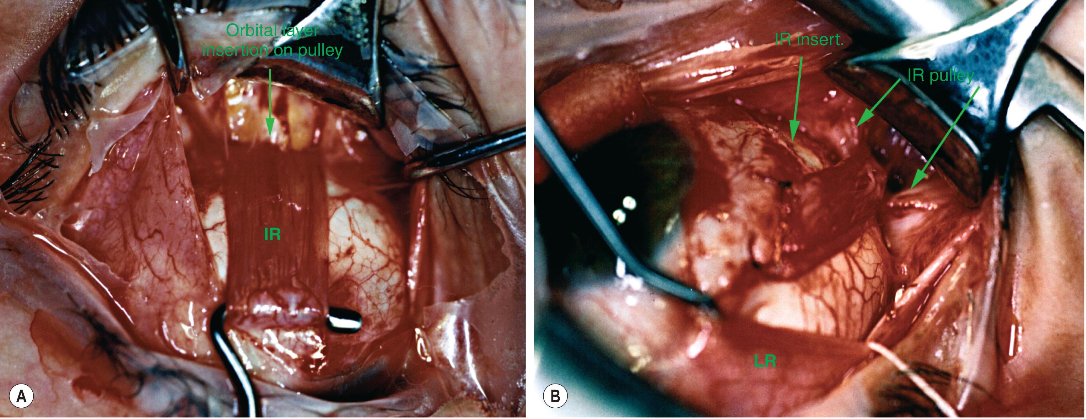 Fig. 75.5, Surgical exposure of right inferior rectus (IR) region, as seen from above the patient, using incision at the conjunctival limbus. The lateral rectus (LR) of this patient was palsied; magnetic resonance imaging showed that the deep LR belly was markedly atrophic. (A) Inferior rectus muscle, engaged on hook, courses posteriorly into the glistening white tissue of the IR pulley. Note fine connective tissue bands marking the anterior part of the orbital layer insertion into the pulley; these fibers probably include some attachments to the retractors of the lower eyelid, but the latter are more extensive and posteriorly located. (B) The IR tendon has been disinserted from the sclera, leaving a white line at the original insertion site. The IR tendon has been transposed temporally to adjoin the inferior pole of the insertion of the paralyzed LR muscle. Note the diagonal path of the transposed IR towards the original location of the IR pulley, now more visible as a discrete structure.