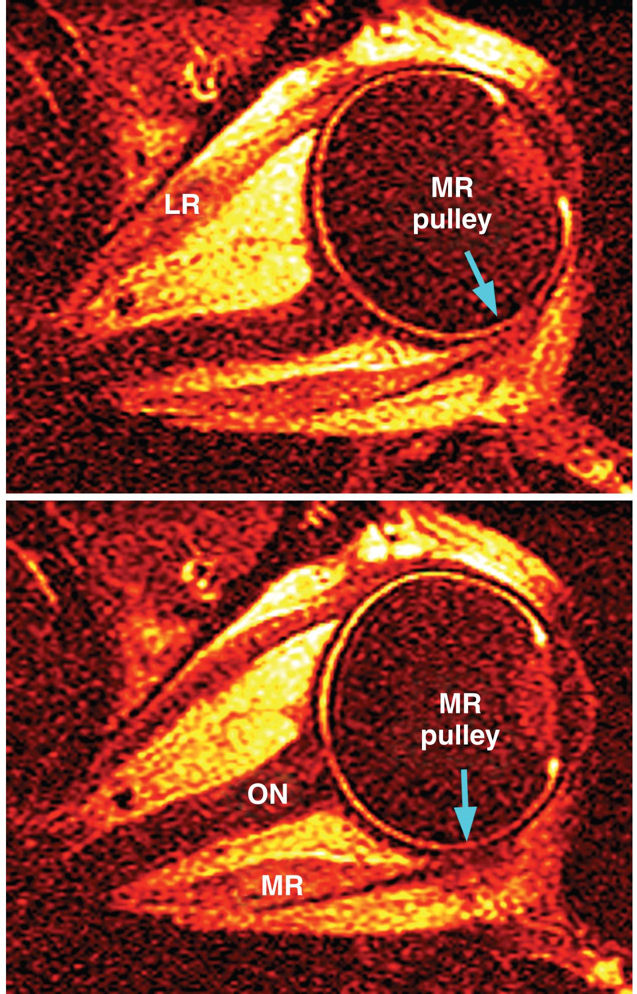 Fig. 75.6, Gadodiamide contrast-enhanced axial magnetic resonance image scans of a right orbit in central gaze and in abduction. Note that the medial rectus (MR) pulley moves anteriorly in abduction by the same amount as the MR insertion. LR, lateral rectus muscle; ON, optic nerve.