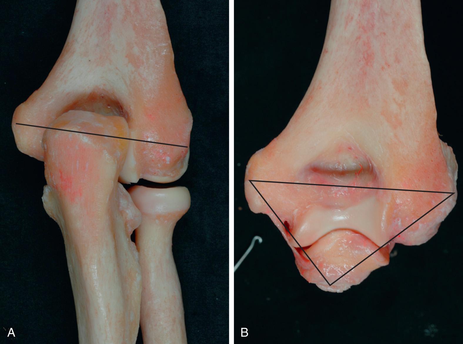 FIG 2.1, The palpable landmarks of the tip of the olecranon and the medial and lateral epicondyles are collinear with the elbow extended (A) and form an inverted triangle posteriorly when the elbow is flexed 90 degrees (B).