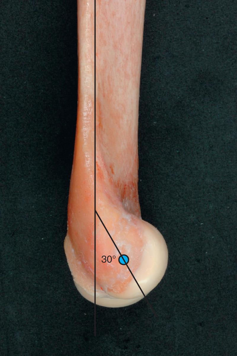 FIG 2.12, Lateral view of the humerus shows the 30-degree anterior rotation of the articular condyles with respect to the long axis of the humerus.
