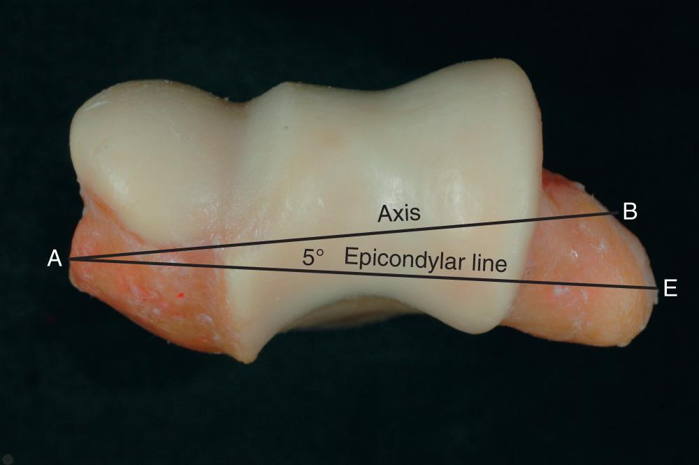 FIG 2.13, Axial view of the distal humerus shows the isometric trochlea as well as the anterior position of the capitellum. The trochlear capitellar groove separates the trochlea from the capitellum. The flexion axis, AB , is about 5 degrees anteriorly rotated compared to the epicondylar line, AE .