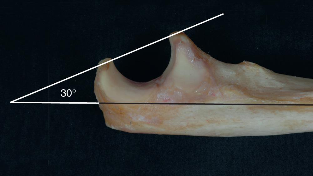 FIG 2.15, The greater sigmoid notch opens posteriorly with respect to the long axis of the ulna. This matches the 30-degree anterior rotation of the distal humerus, as shown in Fig. 2.12 .