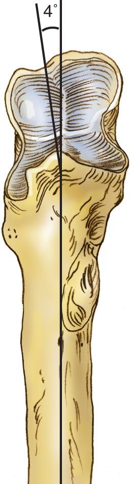 FIG 2.16, There is a slight (approximately 4 degrees) valgus angulation of the shaft of the ulna with respect to the greater sigmoid notch.