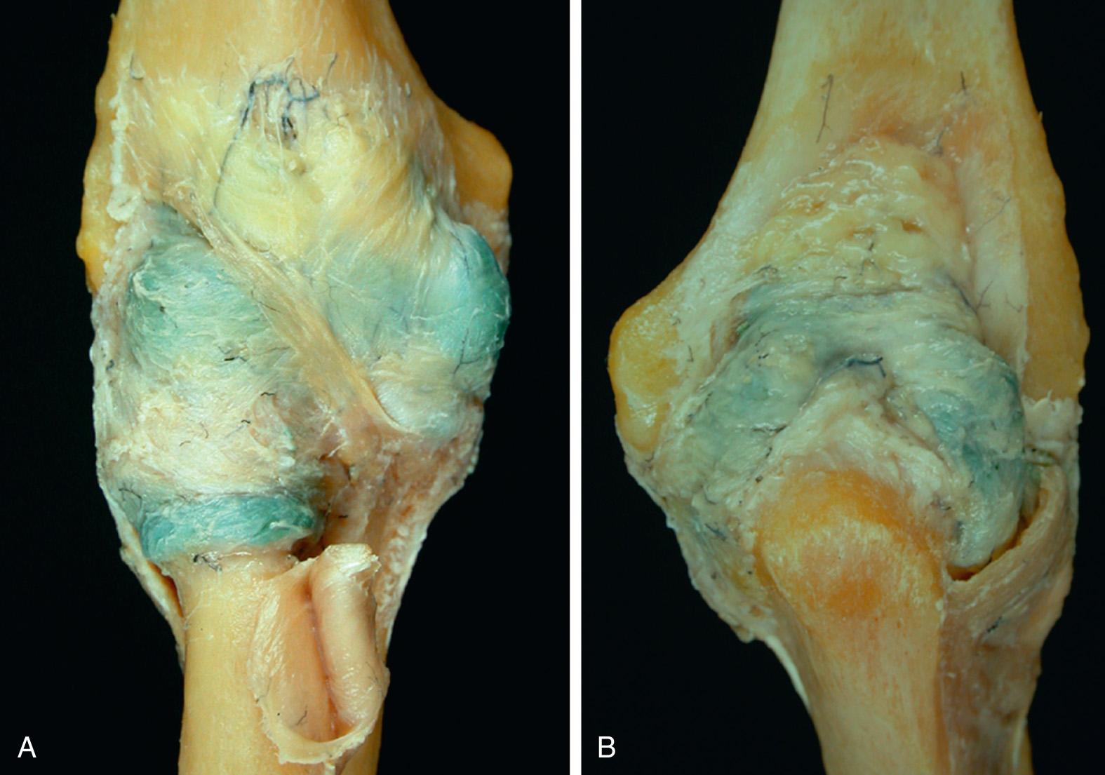 FIG 2.18, Dye distends the capsule. Note the extension of the capsule in the sacciform recess of the radial head and the complex network of fibrous support to the capsule (A). Distribution of the synovial membrane from the posterior aspect, demonstrating the presence of the synovial recess under the annular ligament and about the proximal ulna (B).