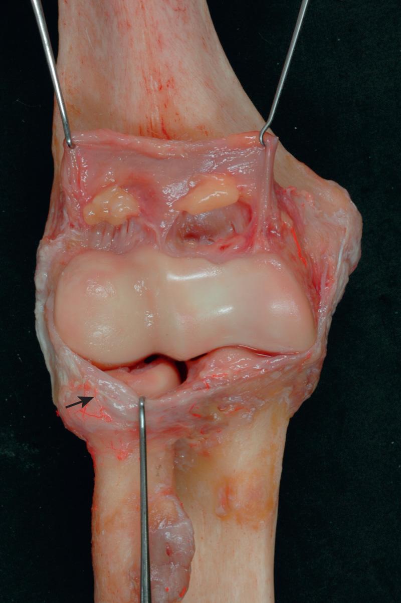 FIG 2.19, The radial synovial plica (arrow) originates from the proximal lateral capsule and courses distally and medially, enveloping a portion of the radial head.