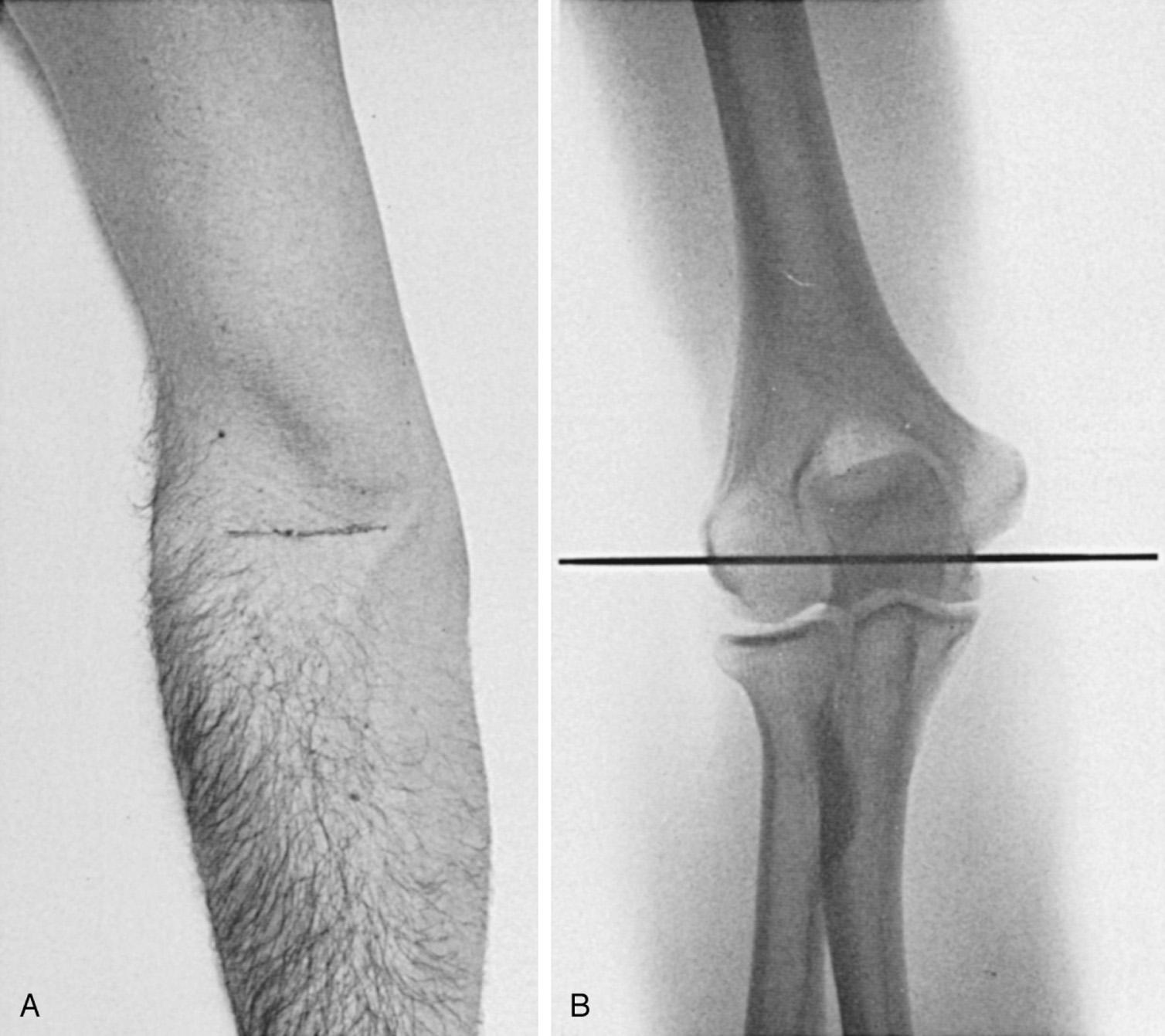 FIG 2.2, A line placed over the flexion crease (A) is actually situated approximately 1 cm above the elbow joint line (B).