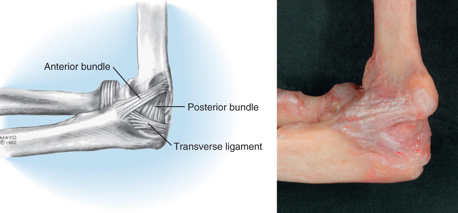 FIG 2.21, The classic orientation of the medial collateral ligament, including the anterior and posterior bundles, and the transverse ligament. This last structure contributes relatively little to elbow stability.