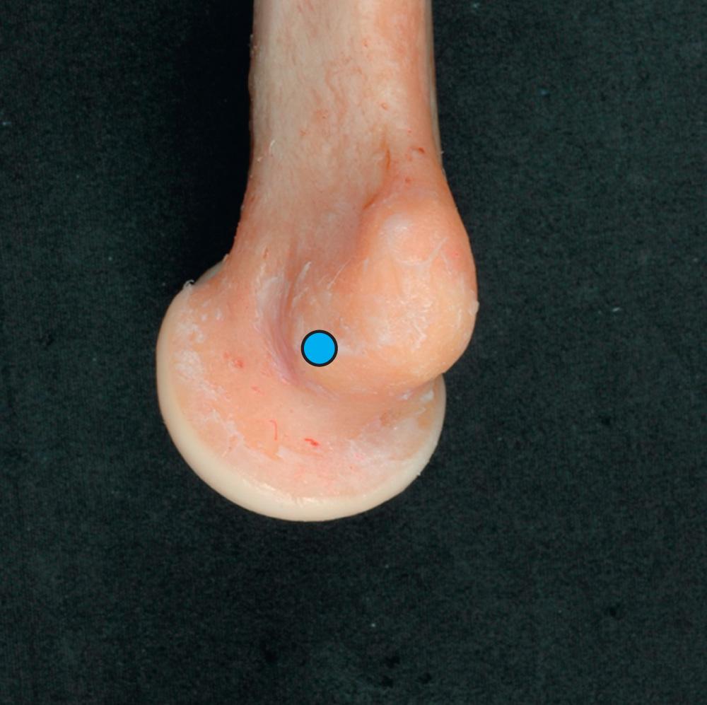 FIG 2.22, The origin of the medial complex is at the axis of rotation, which is located at the anterior inferior aspect of the medial epicondyle. This is the projected center of the trochlea.