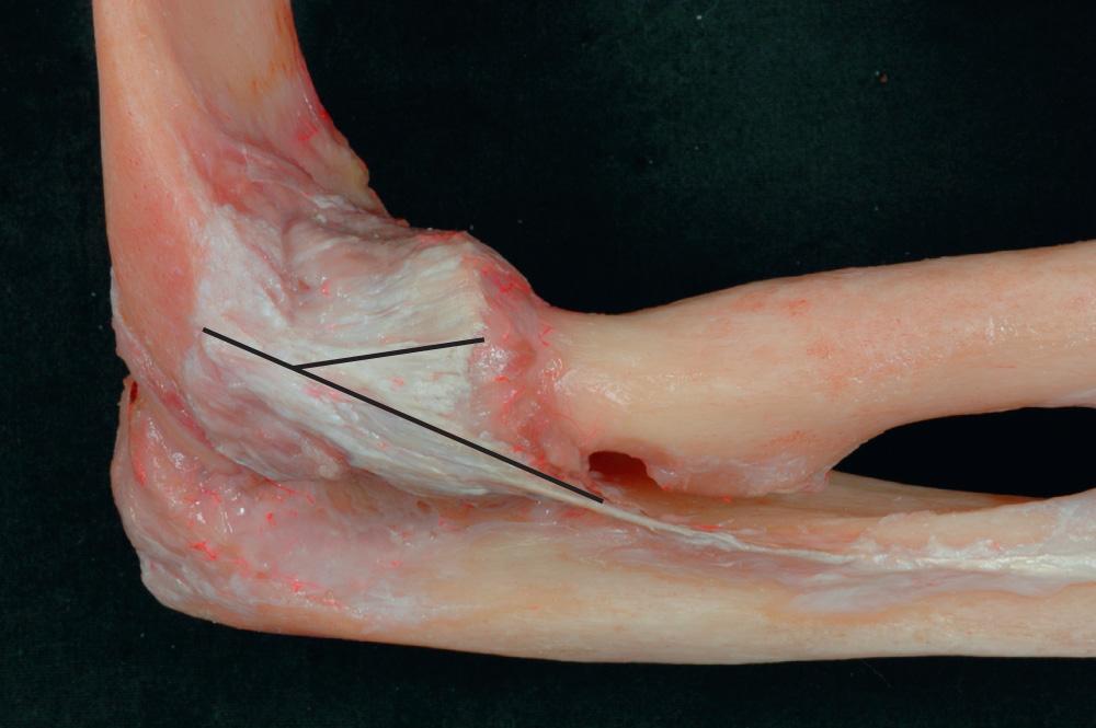 FIG 2.23, Dissection demonstrating the “Y” orientation of the lateral collateral ligament complex.