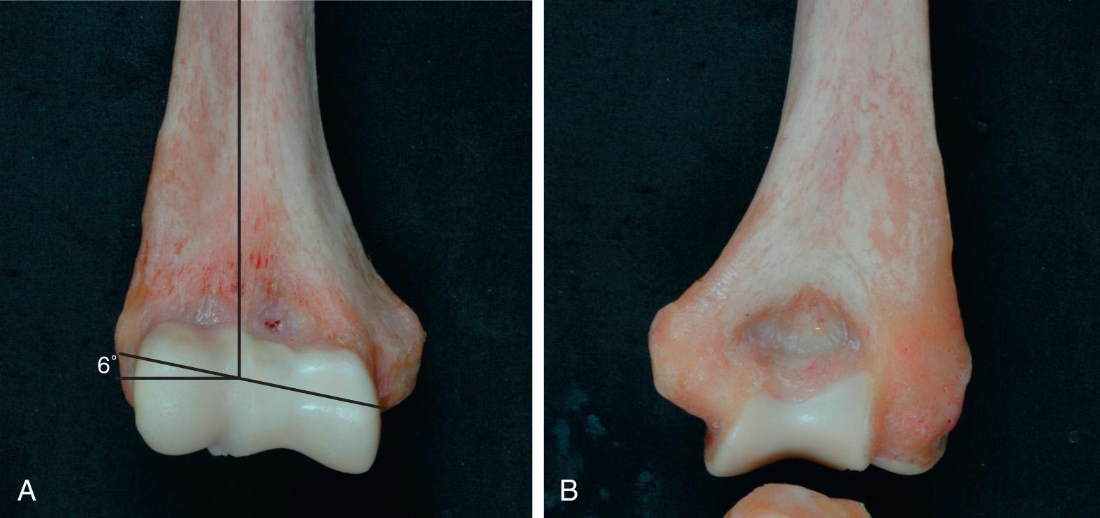 FIG 2.5, (A) The bony landmarks of the anterior aspect of the distal humerus. Note the 6-degree valgus angulation of the flexion axis and long axis of the humerus. (B) The prominent medial and lateral supracondylar bony columns as well as other landmarks of the posterior aspect of the distal humerus.