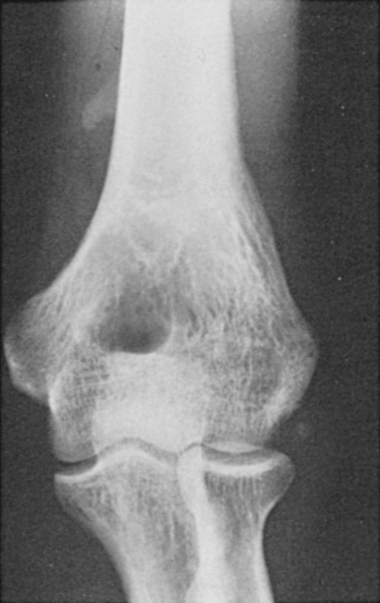 FIG 2.6, Typical supracondylar process located approximately 5 cm proximal to the medial epicondyle with its characteristic configuration.