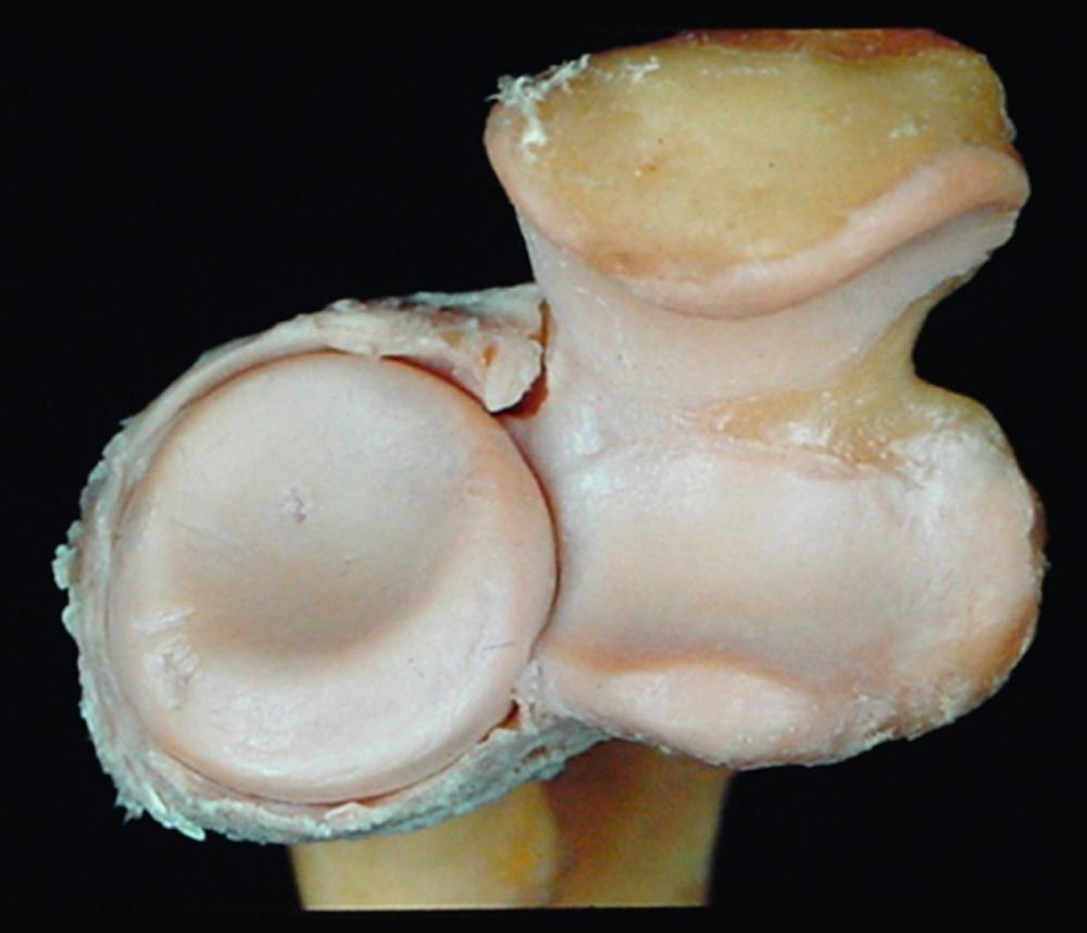 FIG 2.7, The elliptical radial head is stabilized to the lesser sigmoid notch of the ulna. Note the symmetrical, circular portion that articulates with the capitellum.