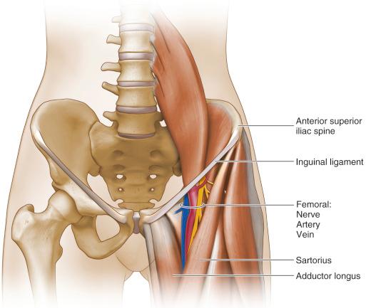 Fig. 12.1, The anterior superior iliac spine represents the anterior prominence of the iliac crest. The femoral triangle is bordered superiorly by the inguinal ligament, laterally by the sartorius, and medially by the adductor longus, and the floor by the iliopsoas, the pectineus, and the adductor brevis. Within the triangle, the artery is positioned adjacent to the femoral nerve laterally and the femoral vein medially.