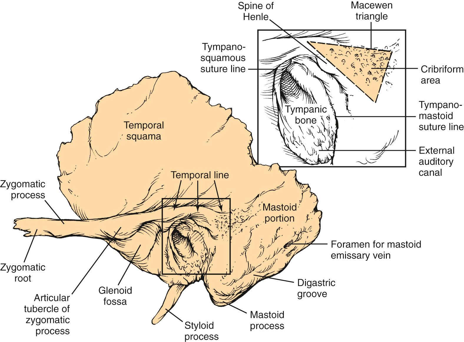 Fig. 126.1, Lateral view of left temporal bone surface shows squamous, tympanic, and mastoid portions.