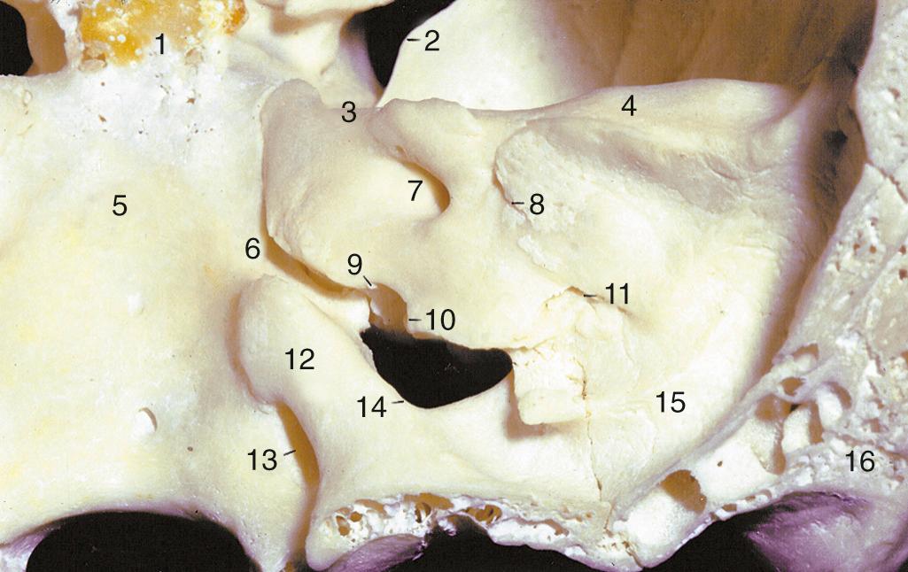 Fig. 126.4, Medial view of petrous bone (right side).