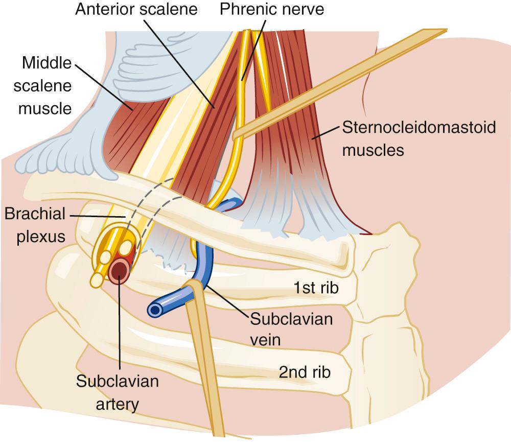 FIGURE 1-2, Cervicoaxillary canal and the structures that traverse this opening.