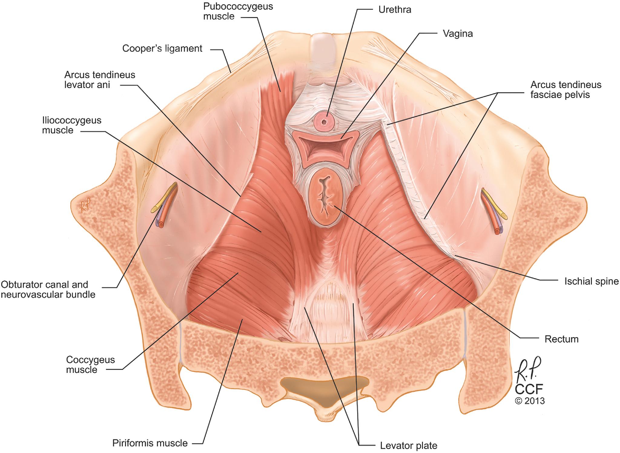 Fig. 1.2, The relationships of the muscles of the pelvic floor and sidewalls and their attachments from an abdominal view. The arcus tendineus fasciae pelvis has been removed on the left, showing the origins of the levator ani muscles. On the right, the arcus tendineus fasciae pelvis remains intact, showing the attachment of the lateral vagina via the endopelvic fascia (cut away).