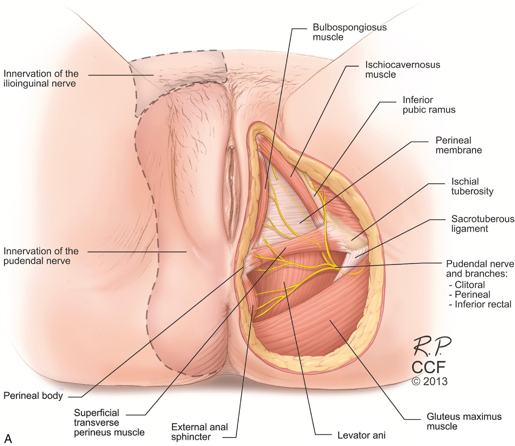 Fig. 1.8, A , Neurovascular anatomy of perineum, illustrating the muscles and nerves of the perineum, including the distribution of the pudendal and ilioinguinal innervation (shaded on left). B , Schematic view of exposed superficial space of anterior perineal triangle showing vulvar structures including the clitoris and the path of the dorsal nerve and artery of the clitoris. a., Artery; BS , bulbospongiosus muscle; IC , ischiocavernosus muscle; IT , ischial tuberosity; n., nerve; PS , pubic symphysis.