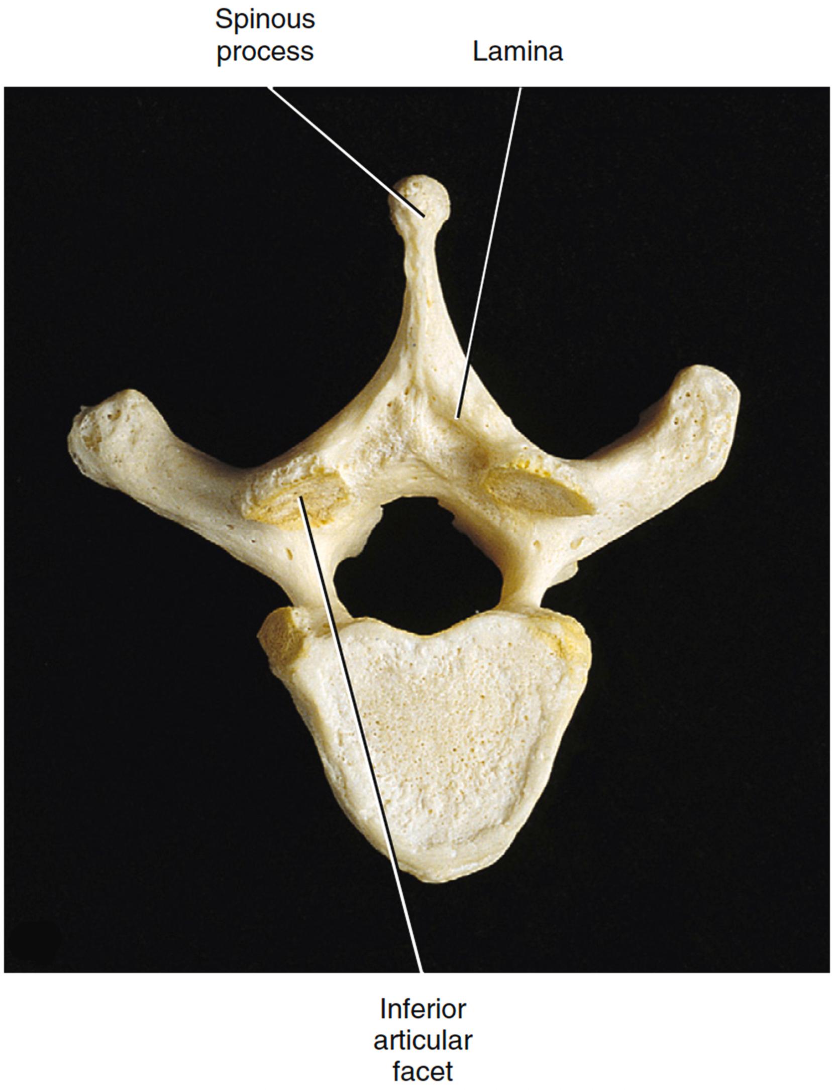 Figure 1.2, Basic structure of vertebrae, viewed inferiorly. Cramer, G., & Darby, S. (2014).