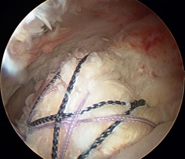 FIG. 10.4, A double-row, suture-bridging rotator cuff repair in which the sutures from the medial row anchors are passed through the rotator cuff tendon as a mattress stitch, tied in a knot, and then fixed laterally in the knotless anchor to compress the tendon onto the greater tuberosity, restoring the footprint attachment.