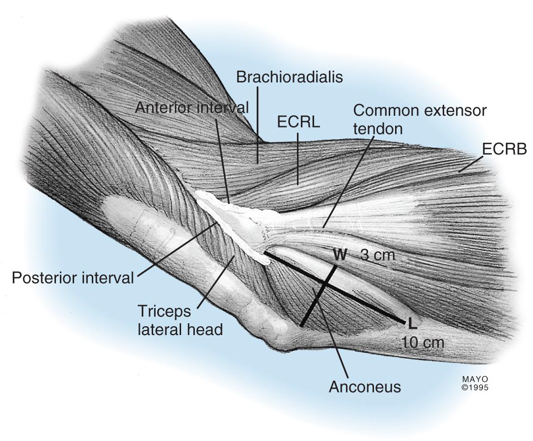 FIG 113.1, The mean dimensions of the anconeus muscle are 9 to 10 cm in length and 3.0 to 3.5 cm in width at its fascial attachment to the triceps. ECRB, Extensor carpi radialis brevis; ECRL, extensor carpi radialis longus; L, length; W, width.