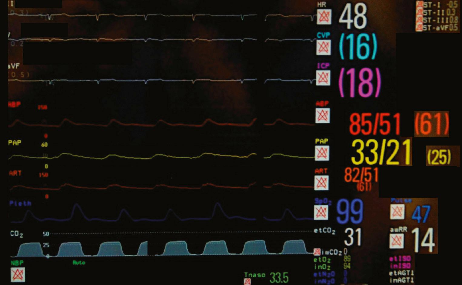 FIGURE 59-1, Monitoring. Parameters monitored during complex cardiac surgery include a multiple-lead electrocardiogram, intracranial pressure, pulmonary artery pressure, one or multiple arterial lines, pulse oxymetry, capnogram, and nasopharyngeal temperature.