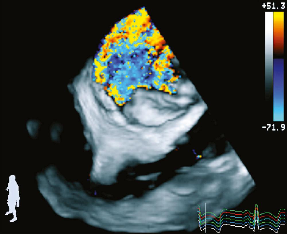 FIGURE 59-2, Three-dimensional color flow Doppler. Three-dimensional transesophageal echocardiographic image of a mitral regurgitation jet that extends throughout the coaptation line.