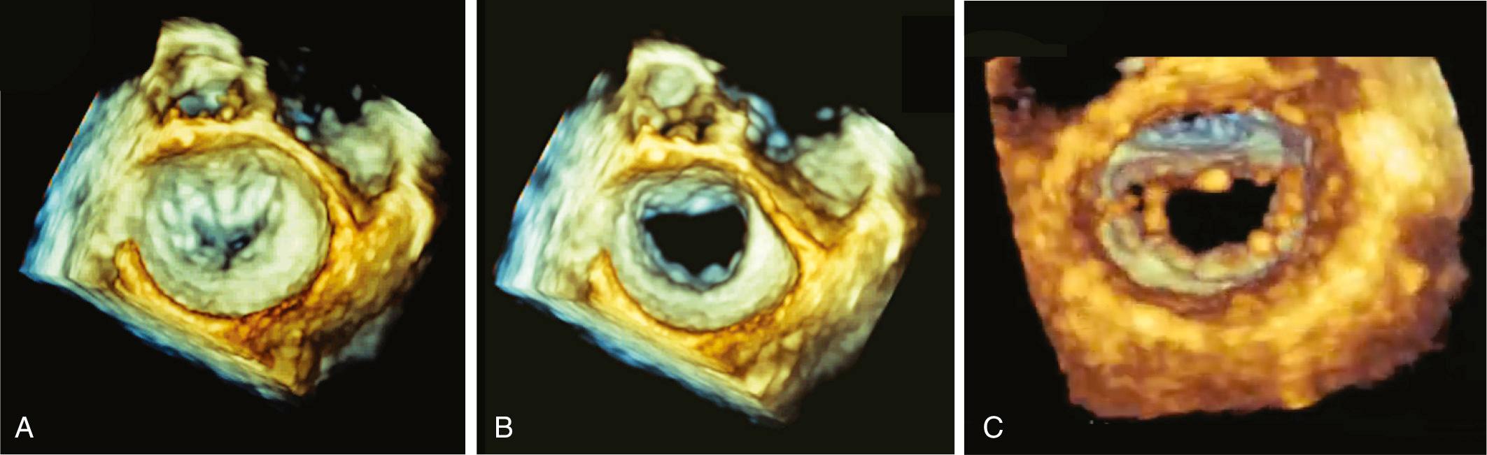 FIGURE 59-3, Mitral valve open/closed. En face view of the mitral valve obtained with three-dimensional transesophageal echocardiography demonstrates the valve in a closed (A) and open position (B). The image can then be rotated to reveal valve anatomy as seen from the left ventricle (C).