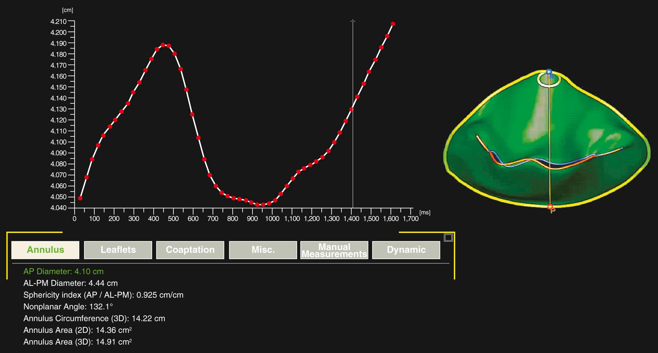 FIGURE 59-4, AP diameter. Three-dimensional echocardiographic imaging may allow for better visualization of heart anatomy and the changes it undergoes throughout the cardiac cycle. A three-dimensional reconstruction of the mitral valve and the changes it undergoes in its AP annular diameter is demonstrated here. AL, Anterolateral; AP, anteroposterior; PM, posteromedial.