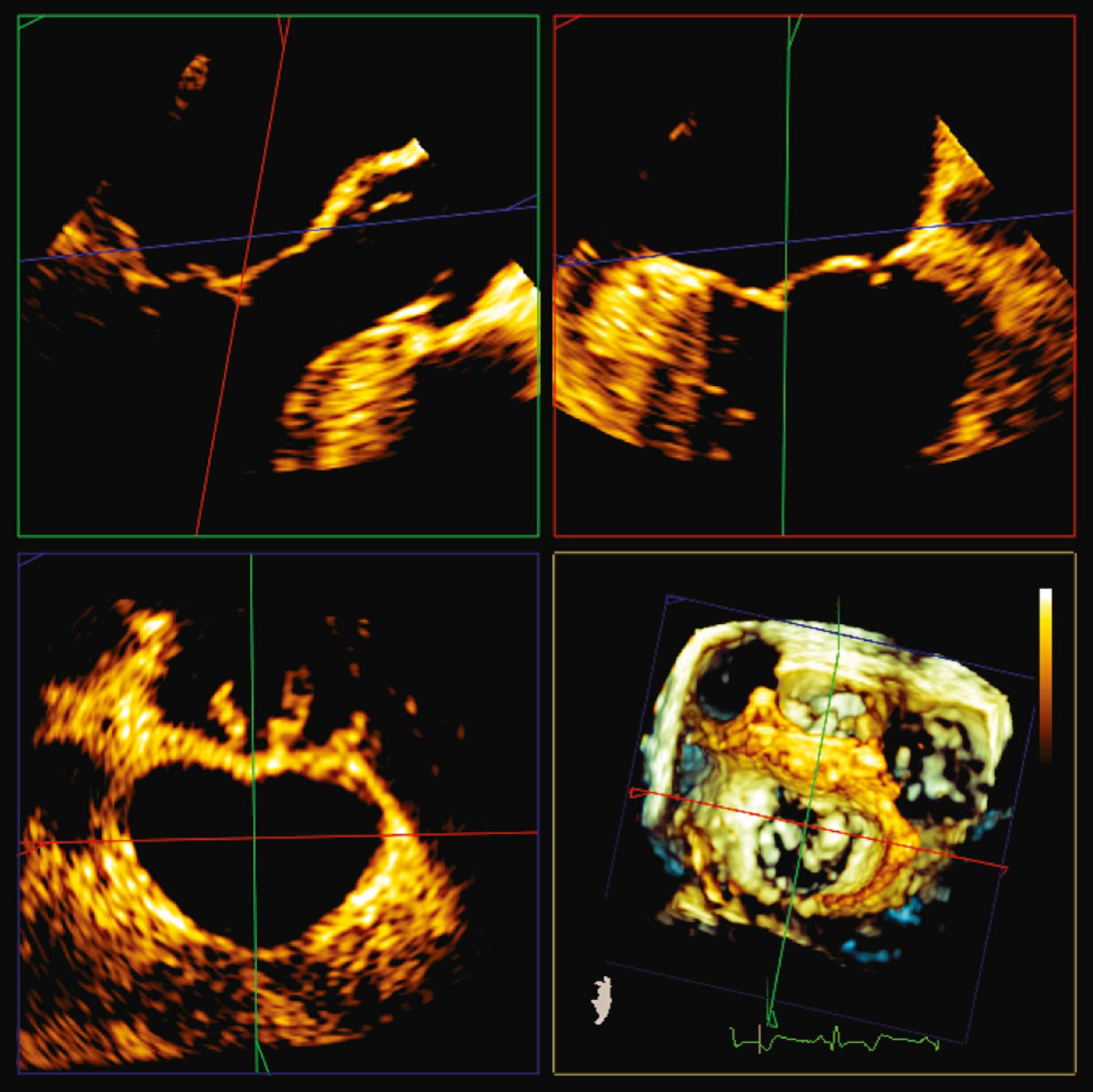 FIGURE 59-5, Multiplanar reformatting (MPR) of three-dimensional echocardiographic images can allow for more precise measurements by aligning orthogonal planes across structures of interest. In this case the planes are aligned so that the area and diameters of the mitral annulus (bottom left) can be measured.