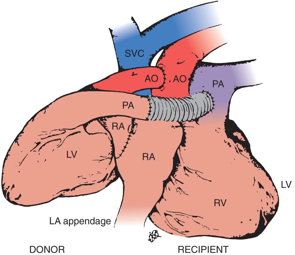 Fig. 19.2, Placement of heterotopic graft in the right chest, with anastomoses to the corresponding native left (LA) and right atria (RA), ascending aorta (AO), and an interposition graft to the native pulmonary artery (PA) . LV, left ventricle; RV, right ventricle; SVC, superior vena cava.