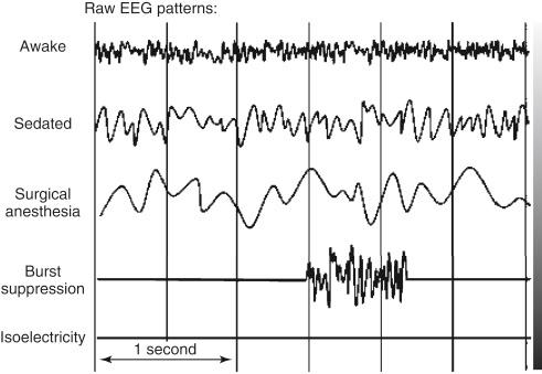 FIGURE 46-1, Electroencephalographic (EEG) patterns at different stages of anesthesia.