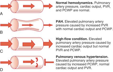 FIGURE 46-4, Pathophysiology of portopulmonary hypertension. PAH , Pulmonary artery hypertension; PCWP , pulmonary capillary wedge pressure; PVR , pulmonary vascular resistance.