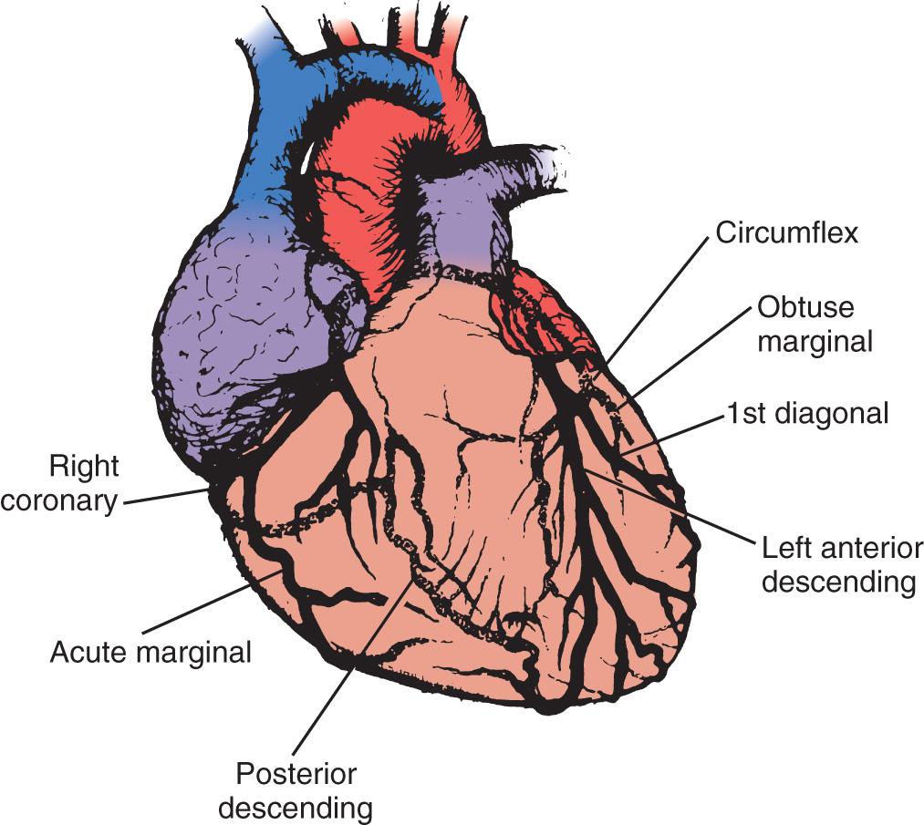 Fig. 14.3, Ten-degree right anterior oblique angiographic view of the heart, which best shows the left main coronary artery dividing into the circumflex and left anterior descending arteries. Lines indicate common sites of distal vein graft anastomoses.