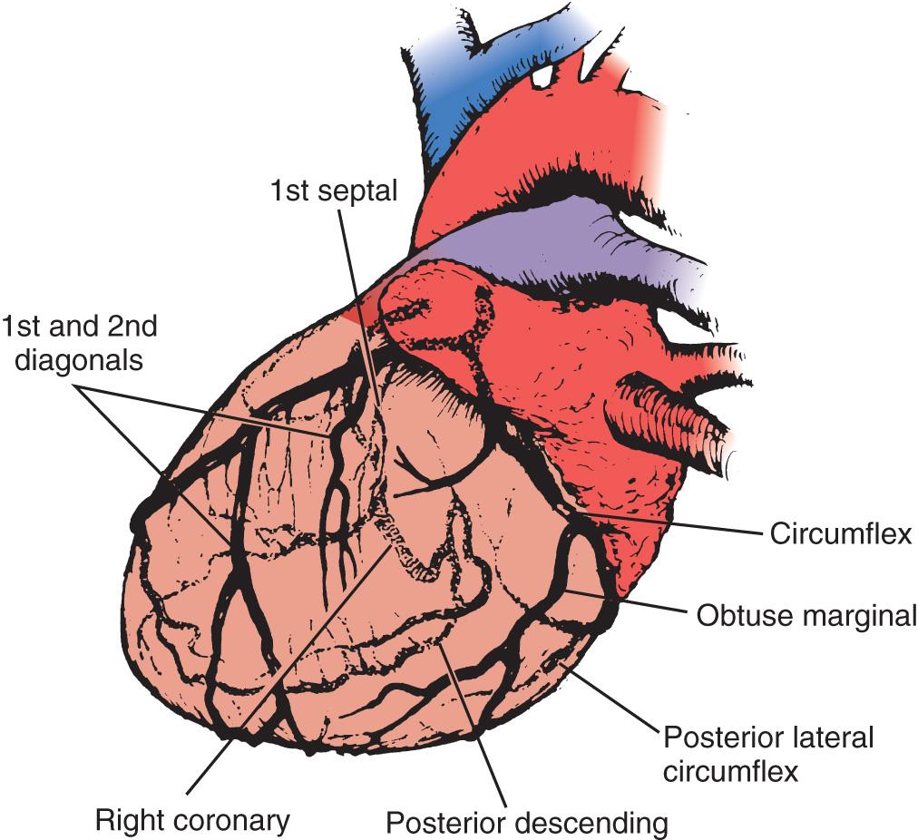 Fig. 14.4, Seventy-five–degree left anterior oblique angiographic view of the heart, which best shows branches of the left anterior descending and circumflex coronary arteries. Lines indicate common sites of distal vein graft anastomoses .