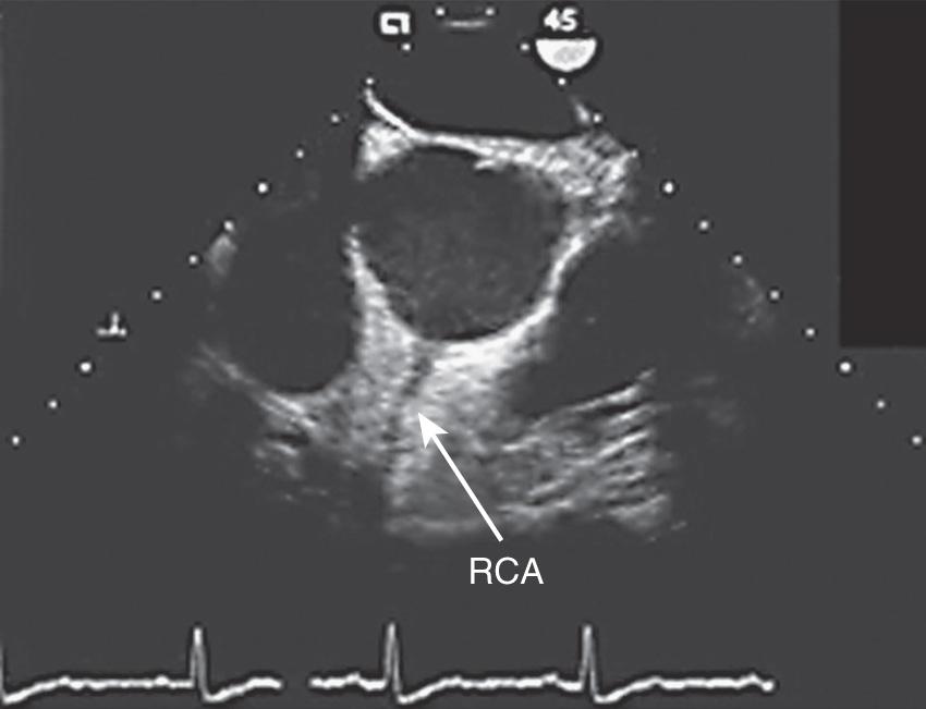 Fig. 14.5, The vertical and superior orientation of the right coronary artery (RCA) arising from the aortic root is identified by transesophageal echocardiography (TEE). The TEE transducer in the esophagus is at the top of the screen, and the patient's chest wall is at the bottom. Retained air preferentially enters the RCA, which may cause inferior ischemia, depending on the amount of air and the coronary perfusion pressure. Elevation of perfusion pressure using phenylephrine is often used to treat coronary air embolus. The left main coronary artery (not visible) arises at approximately 3 o'clock on this image.